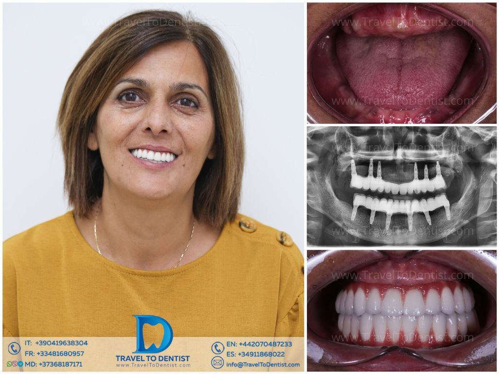 Caso de tratamiento dental #5