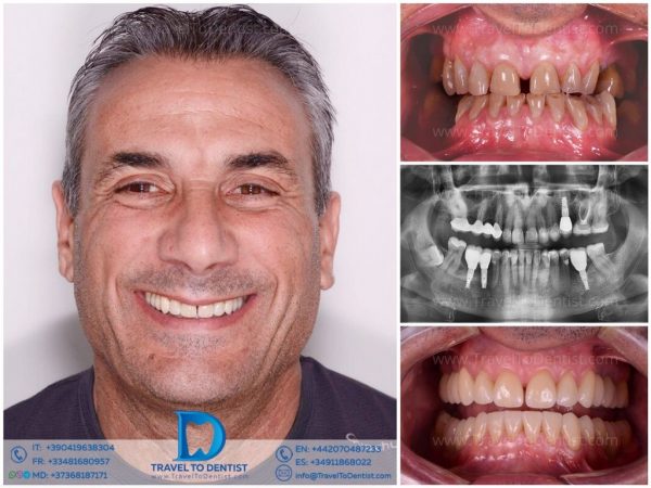 Caso de tratamiento dental #2 - transformación dental