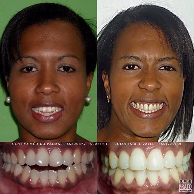 Caso de tratamiento dental #4